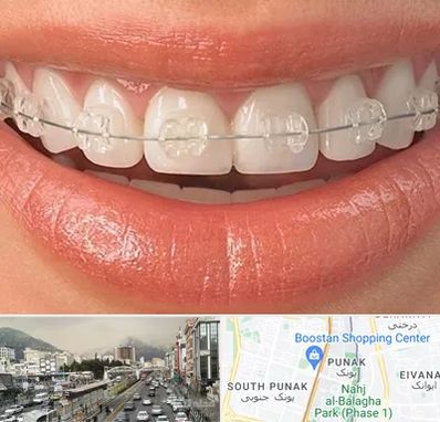 ارتودنسی اقساطی در پونک 