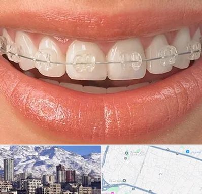 ارتودنسی اقساطی در ازگل