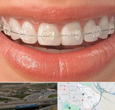 ارتودنسی اقساطی در یاغچیان تبریز