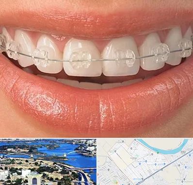 ارتودنسی اقساطی در کوروش اهواز 