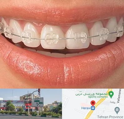 ارتودنسی اقساطی در هروی 