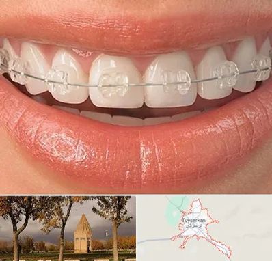 ارتودنسی اقساطی در تویسرکان