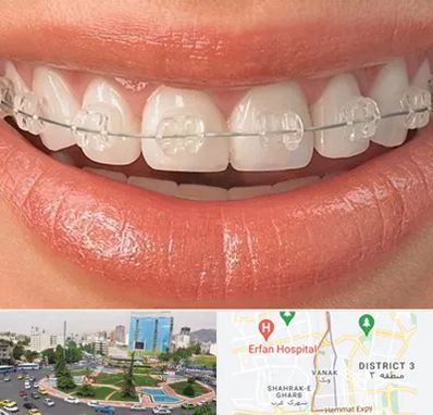 ارتودنسی اقساطی در ونک 