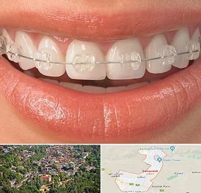 ارتودنسی اقساطی در دماوند