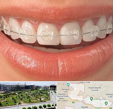 ارتودنسی اقساطی در پردیس