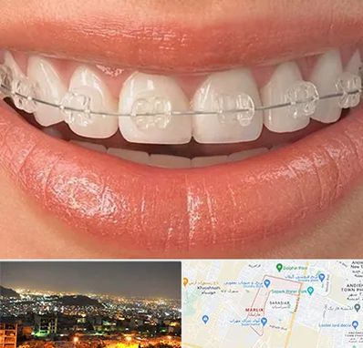 ارتودنسی اقساطی در مارلیک کرج 