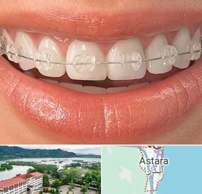 ارتودنسی اقساطی در آستارا