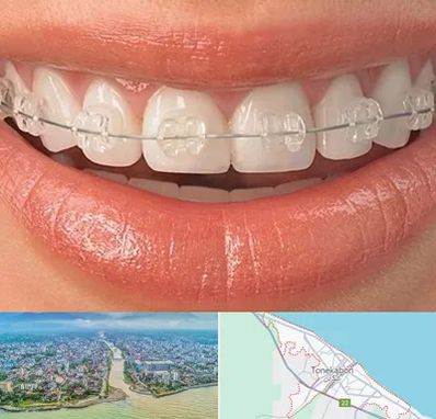 ارتودنسی اقساطی در تنکابن