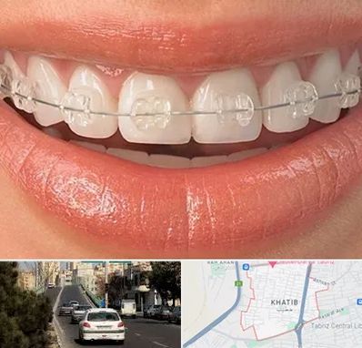 ارتودنسی اقساطی در خطیب تبریز