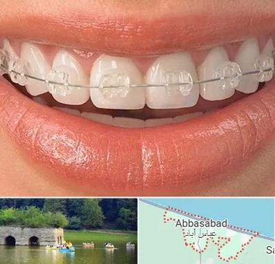 ارتودنسی اقساطی در عباس آباد