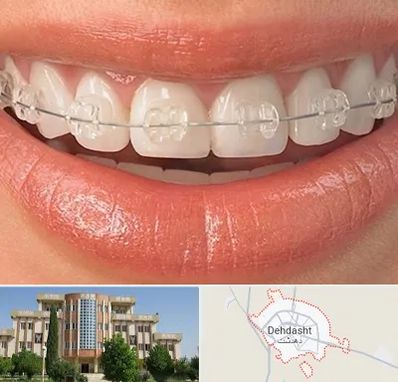 ارتودنسی اقساطی در دهدشت