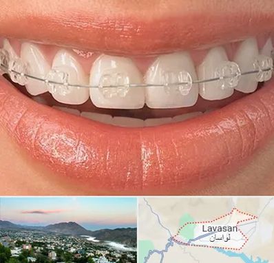 ارتودنسی اقساطی در لواسان