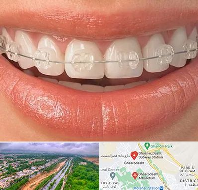 ارتودنسی اقساطی در قصرالدشت شیراز 