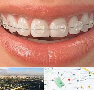 ارتودنسی اقساطی در هنگام 