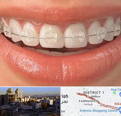 ارتودنسی اقساطی در فرمانیه 