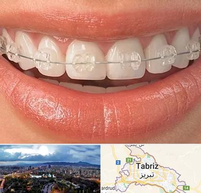 ارتودنسی اقساطی در تبریز