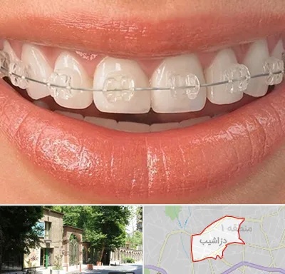 ارتودنسی اقساطی در دزاشیب