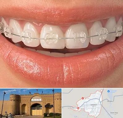ارتودنسی اقساطی در ایرانشهر