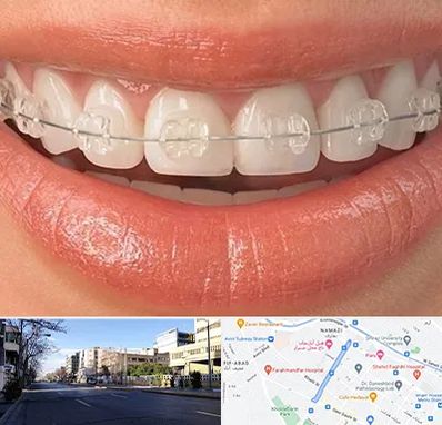 ارتودنسی اقساطی در خیابان ملاصدرا شیراز 