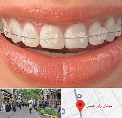 ارتودنسی اقساطی در ولیعصر شهریار
