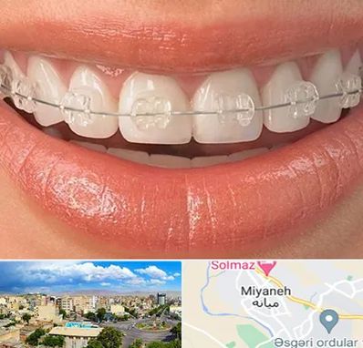 ارتودنسی اقساطی در میانه