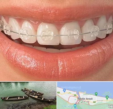 ارتودنسی اقساطی در بندر انزلی