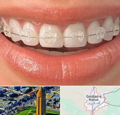 ارتودنسی اقساطی در گنبد کاووس