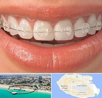 ارتودنسی اقساطی در کیش