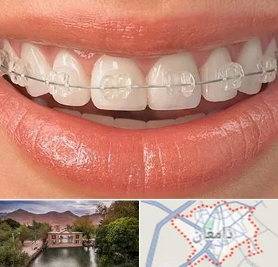 ارتودنسی اقساطی در دامغان