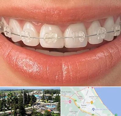 ارتودنسی اقساطی در رودسر