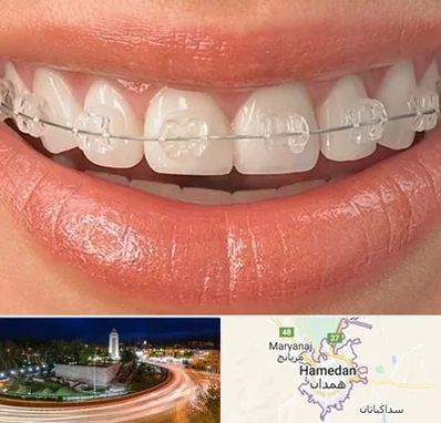 ارتودنسی اقساطی در همدان