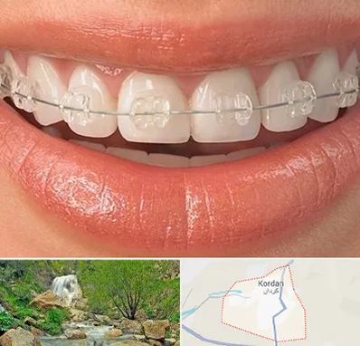 ارتودنسی اقساطی در کردان