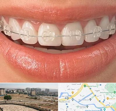 ارتودنسی اقساطی در کوی وحدت شیراز 