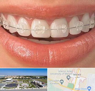 ارتودنسی اقساطی در ملارد