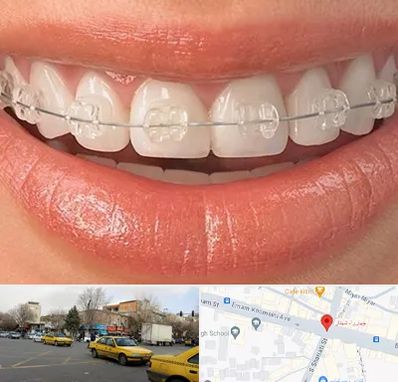 ارتودنسی اقساطی در شهناز تبریز