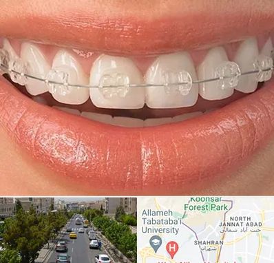 ارتودنسی اقساطی در شهران 