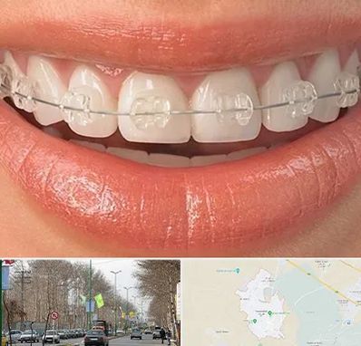 ارتودنسی اقساطی در نظرآباد کرج 