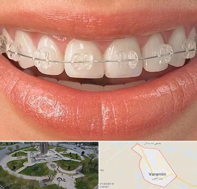 ارتودنسی اقساطی در ورامین