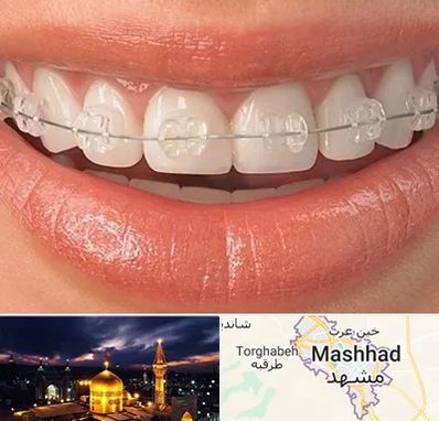ارتودنسی اقساطی در مشهد