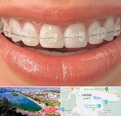 ارتودنسی اقساطی در لاهیجان