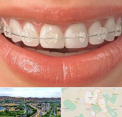 ارتودنسی اقساطی در شهریار