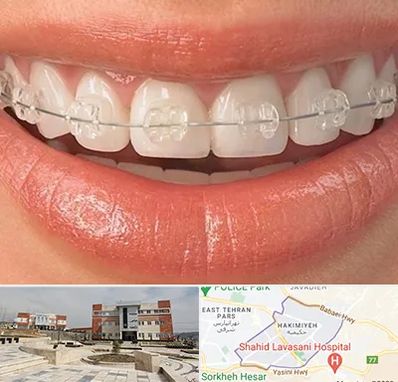 ارتودنسی اقساطی در حکیمیه 