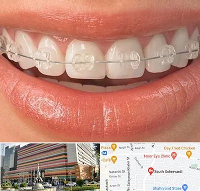 ارتودنسی اقساطی در سهروردی 