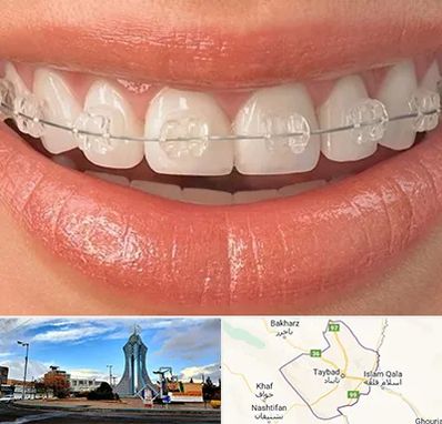 ارتودنسی اقساطی در تایباد