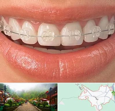 ارتودنسی اقساطی در فومن