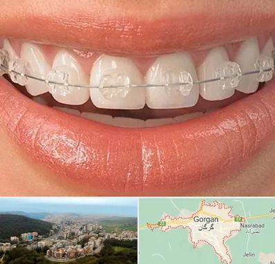 ارتودنسی اقساطی در گرگان