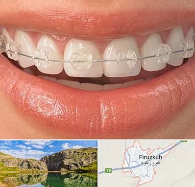 ارتودنسی اقساطی در فیروزکوه