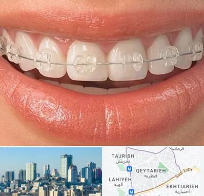 ارتودنسی اقساطی در قیطریه 