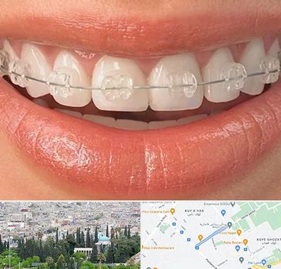 ارتودنسی اقساطی در محلاتی شیراز 