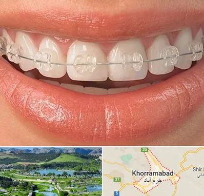 ارتودنسی اقساطی در خرم آباد